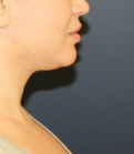 Feel Beautiful - Neck Lipo San Diego - Before Photo